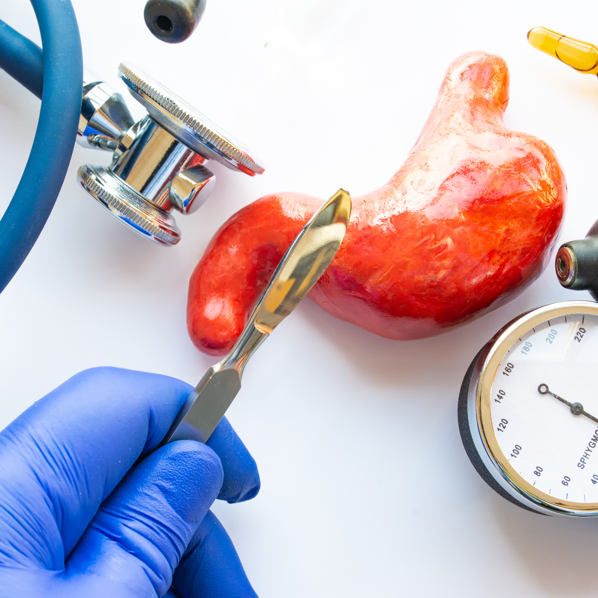 A gloved hand holds a surgical scalpel above a model of a stomach, surrounded by medical tools like a stethoscope and a sphygmomanometer on a white background, illustrating bariatric surgery.