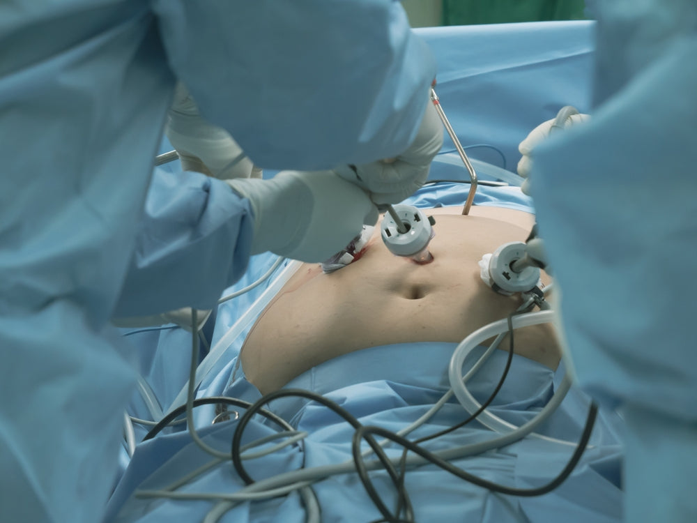 Surgeons in blue scrubs perform a laparoscopic bariatric surgery on a patient, using instruments inserted through small incisions on the abdomen, surrounded by surgical equipment and drapes.