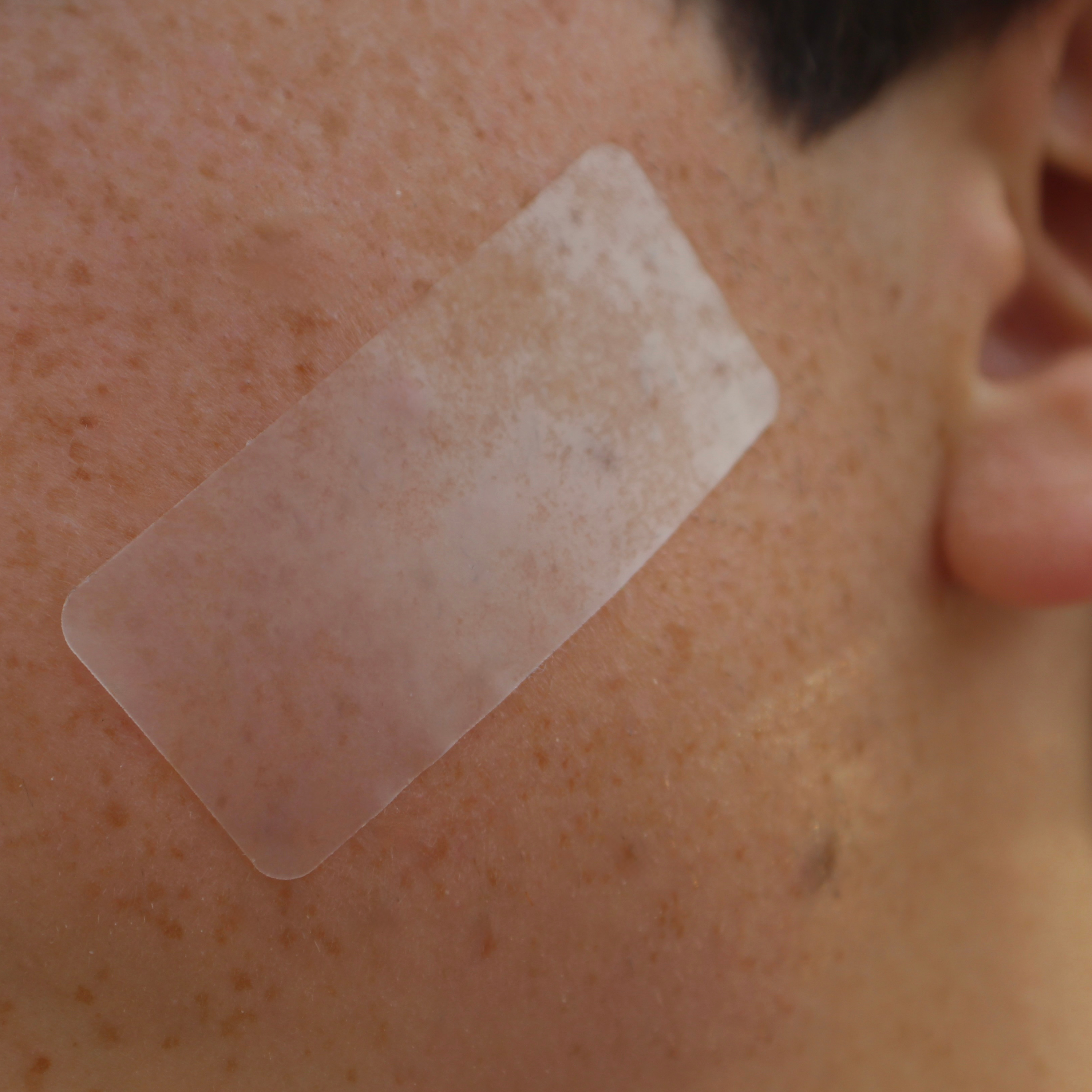 A close-up of a person's skin with a translucent pimple patch strip applied to the cheek, next to the ear.