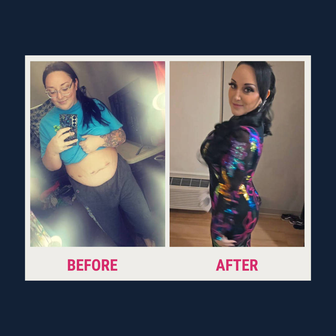 A side-by-side comparison shows a woman before and after surgery; on the left, she wears a blue shirt and gray pants, displaying a post-operative belly, and on the right, she poses confidently in a colorful dress.