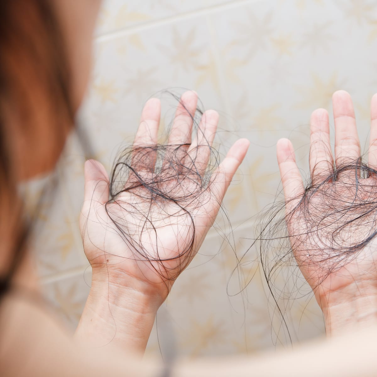 Why Do Most Bariatric Surgery Patients Lose Their Hair?