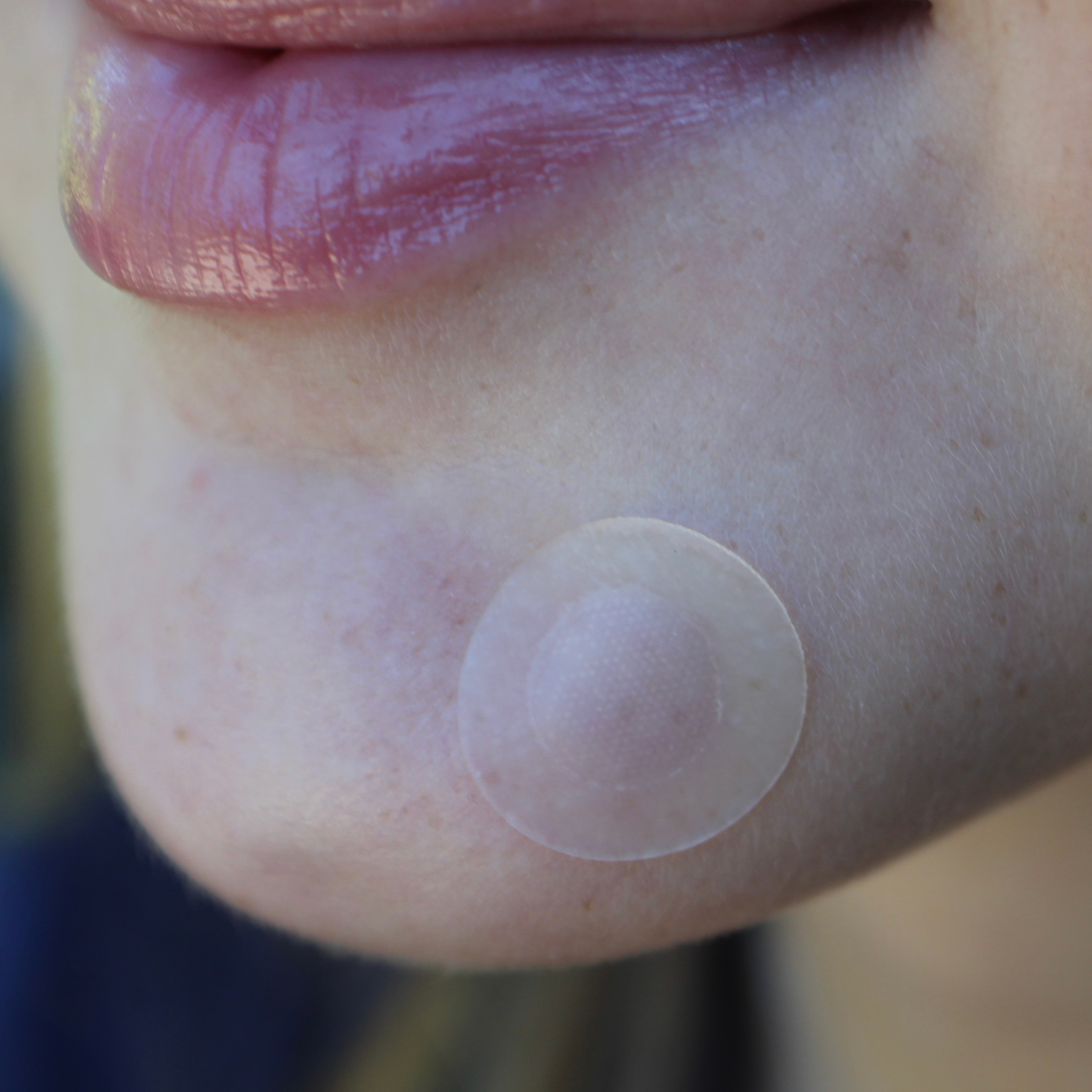 Close-up of a person's chin with a clear microneedle pimple patch on their skin. 
