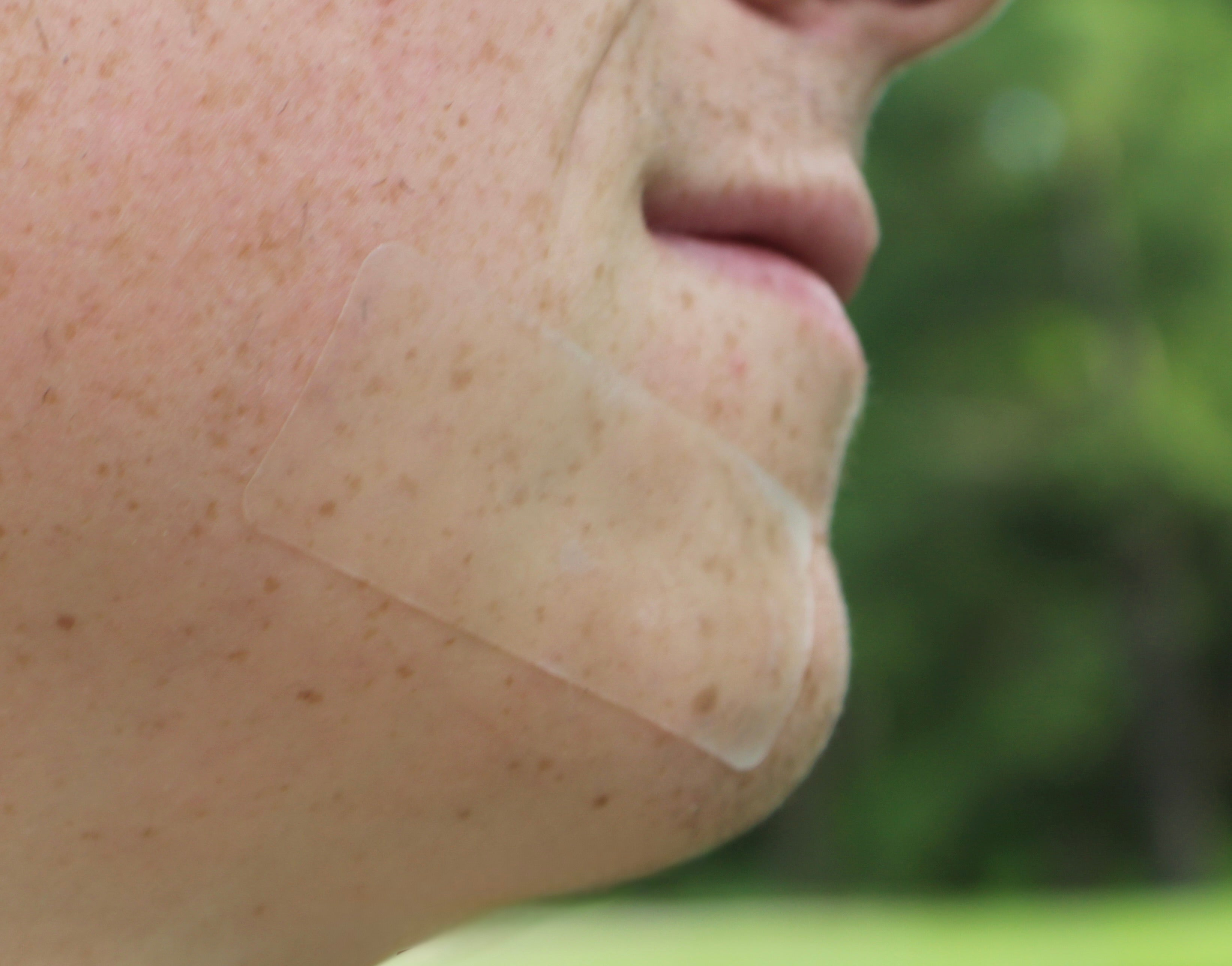 A close-up of a person's cheek and jawline with a transparent pimple patch strip applied to the skin, targeting problem zones. 